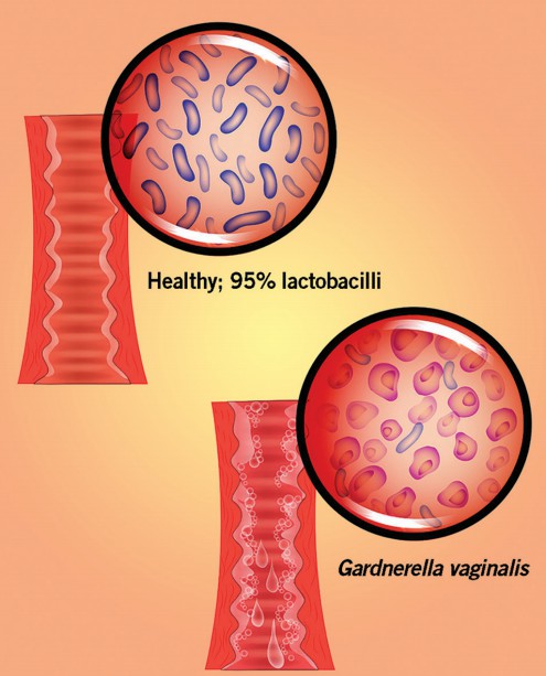 Introduction of bacterial vaginosis