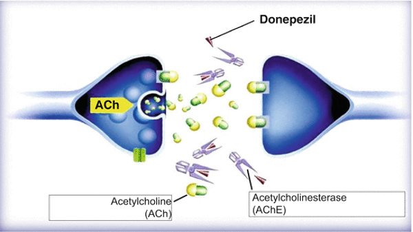 Donepezil impedes AChE resulting in an increase of Ach level in the synaptic cleft