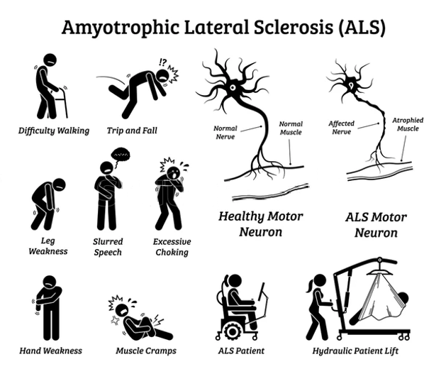 The symptoms of ALS